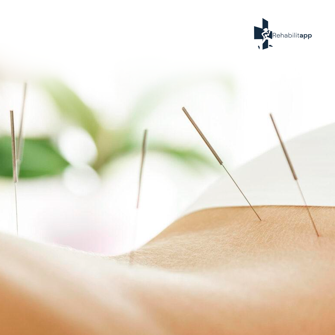 ACUPUNTURA